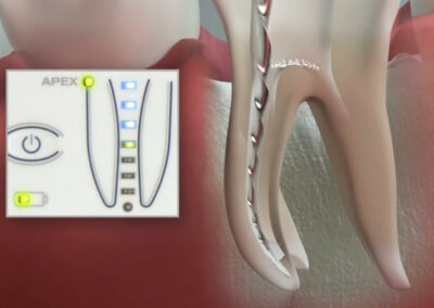 Endometr RECIPROC - Leczenie kanałowe - Nowy Sącz
