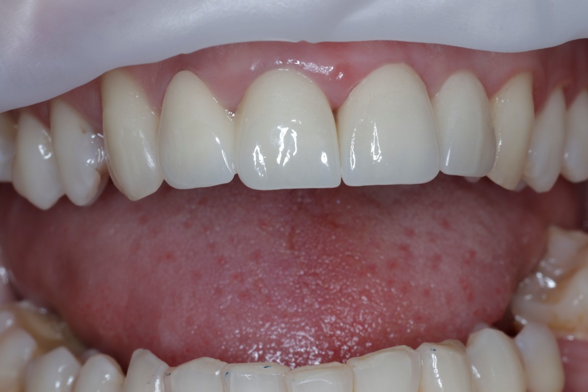 Metamorfoza uśmiechu - po